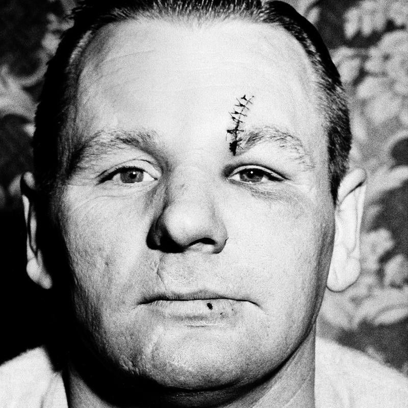Johnny Bower Cleveland Barons ace goalie displays his latest scar